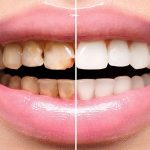 How to Get the Best Dental Veneers